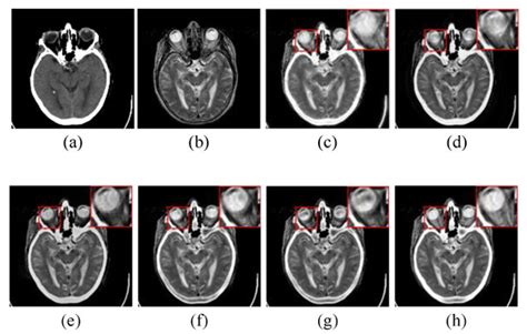MRI Image Fusion Based on Sparse Representation with Measurement of ...