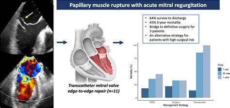 Transcatheter Mitral Valve Edge-to-Edge Repair Following Papillary Muscle Rupture: Clinical ...