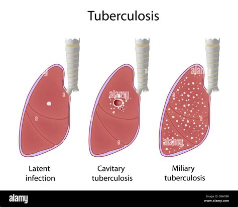Pulmonary tuberculosis, latent infection, cavitary and miliary TB Stock ...