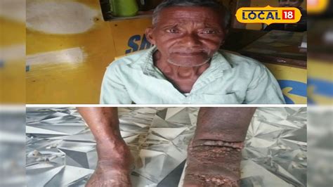 Filariasis Disease: దేశంలో మరో ప్రమాదకర వ్యాధి.. ఎలా వ్యాప్తి ...