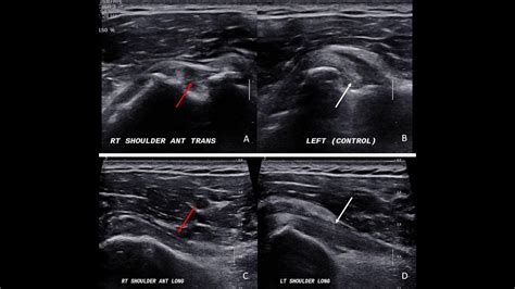 Hip: Normal And Pathology - Internet Book Of MSK Ultrasound