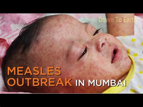 Measles outbreak in Mumbai: 164 cases reported since September