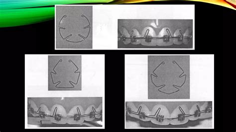 Image result for Auxiliary Root Torque Spring
