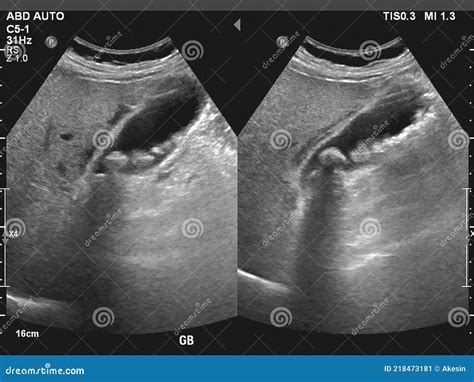 Ultrasonography Image of Gallbladder with Gall Stones at Upper Abdomen Stock Image - Image of ...