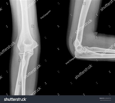 Xray Elbow