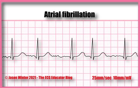 ECG Educator Blog : Atrial Fibrillation (AF)