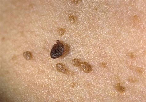 Seborrheic Keratosis: Symptoms, Causes, Diagnosis, and Treatment