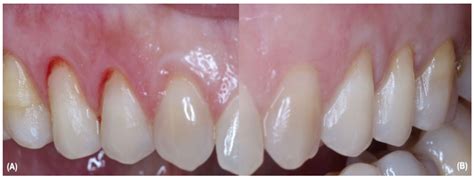 Clinical Evaluation of Bilateral Multiple Gingival Recession Treatment with Autogenous ...
