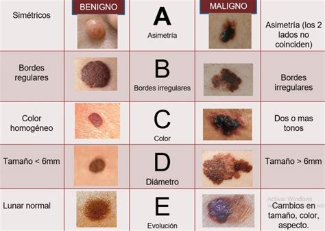 Lipomas quistes y lunares - Centro Dermatológico. Dermae Clinic