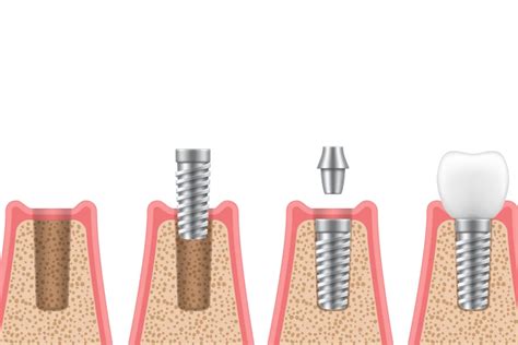 Screwless Dental Implants – The Only Times to Use Them