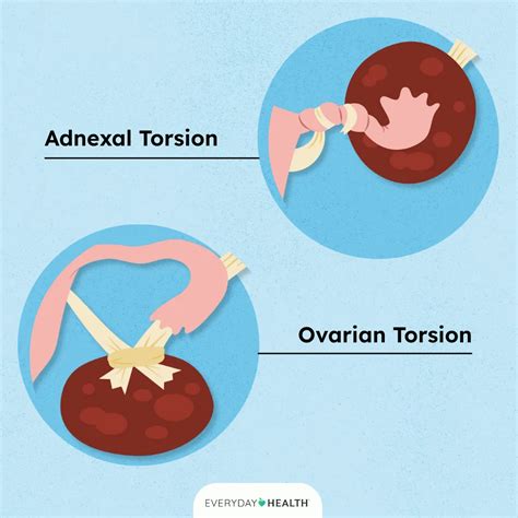Tenderness In Ovaries