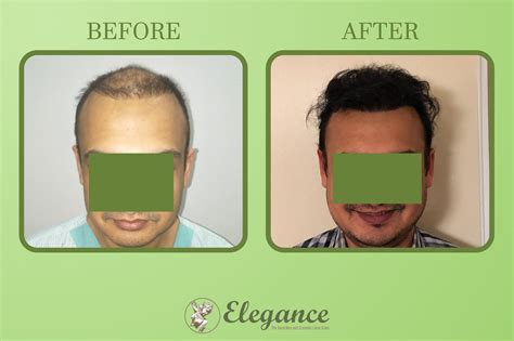Man Hair Transplant in Ahmedabad, Gujarat, India