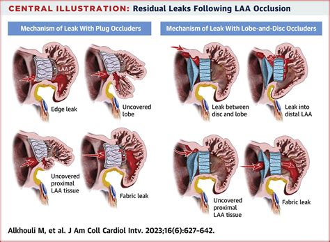 Peridevice Leak After Left Atrial Appendage Occlusion: Incidence ...