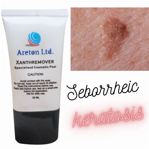 Glycolic Acid Peel Seborrheic keratosis Removal, Dark Spot, Age Spot - Keratosis | eBay