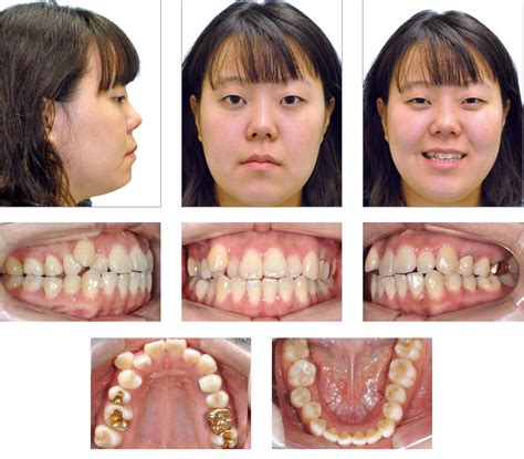 Rapid Palatal Expander Before And After at Madison Calder blog