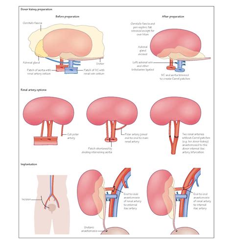 Kidney Transplant Operations
