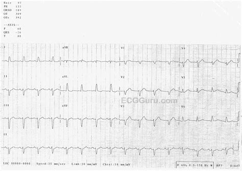 Poor R wave progression | ECG Guru - Instructor Resources