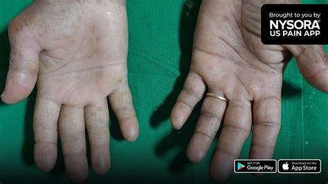 Case study: Carpal tunnel syndrome - Injection - NYSORA