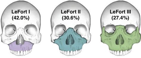 The Characteristics and Cost of Le Fort Fractures: A Review of 519 Cases From a Nationwide ...