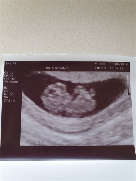 9 Week Abdominal Ultrasound