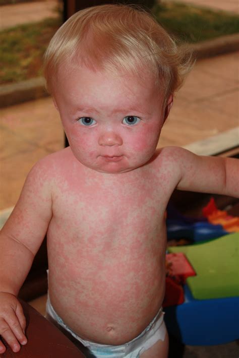 Daily Blog: Diagnosis: Roseola