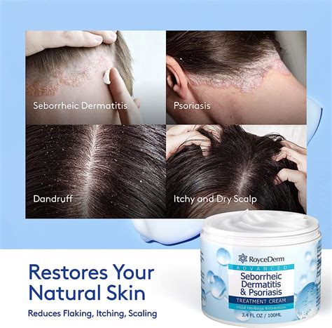 Roycederm Seborrheic Dermatitis Cream - Scalp & Skin Treatment for Psoriasis, Folliculitis ...