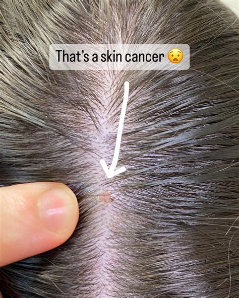 Body Scan Skin Cancer Clinic | This woman in her 20’s has a skin cancer ...