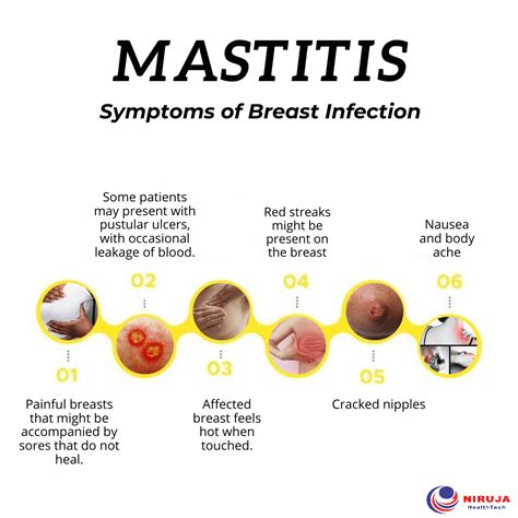 Mastitis: Symptoms of Breast Infection