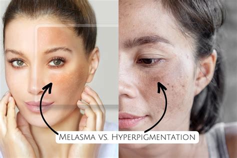 What are the signs and symptoms of Melasma vs. Hyperpigmentation, according to a Dermatologist ...