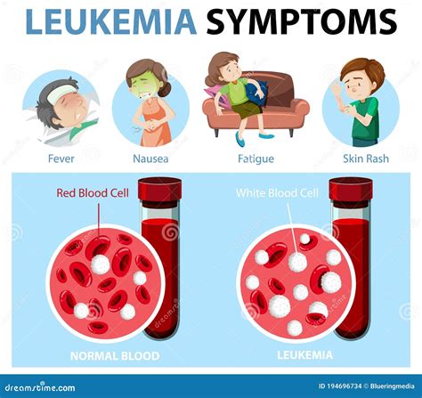 Síntomas De Leucemia Infografía De Estilo Cartográfico Ilustración del Vector - Ilustración de ...