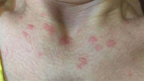Ronchas En La Piel