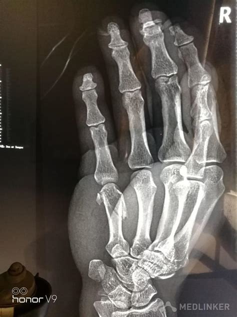 右手第五掌骨骨折-医联