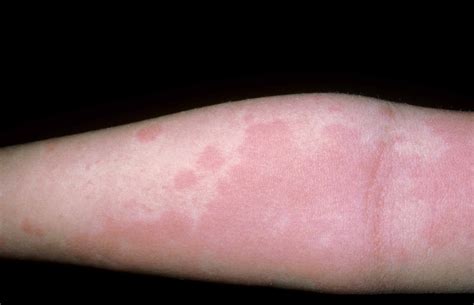 Skin Rash After Flu Shot
