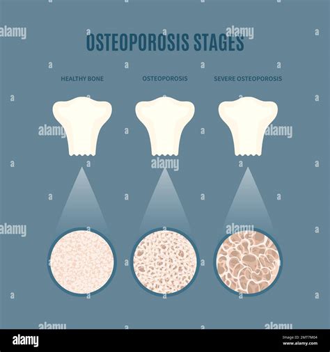 Osteoporosis bone density loss disease medical infographics Stock ...