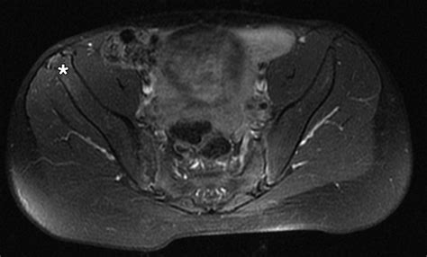 Imaging Findings of Lower Limb Apophysitis | AJR