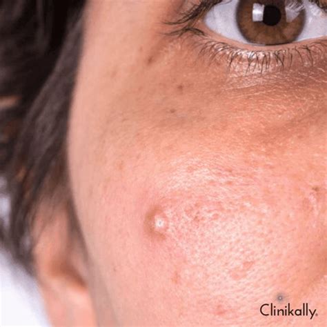 6 DIY Acne Treatment Tips by Dermatologists | Clinikally