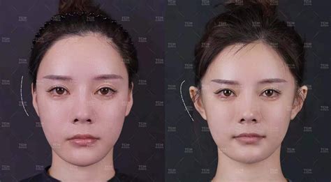 «Էլֆի ականջներ»․ Չինաստանում պլաստիկ վիրահատության տարօրինակ միտում է ...