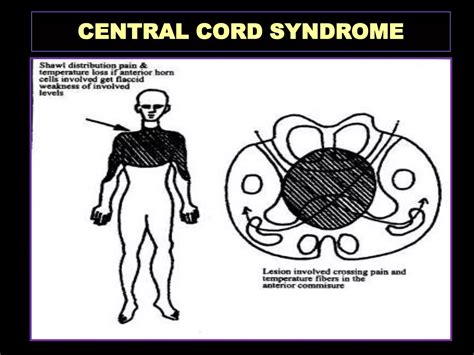 Spinal cord syndromes | PPSX