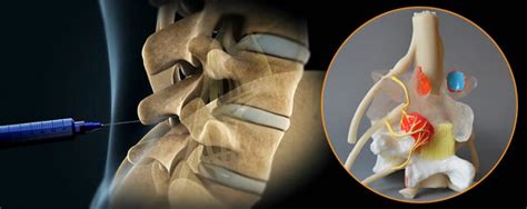 Image result for Lumbar Disc Injection