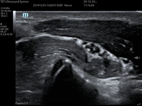 Image result for Mindray Te7 Measurements Tutorial