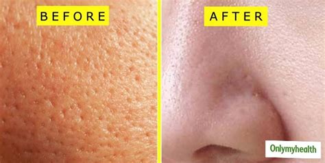 Here's Why And How You Should Use Ice Cubes For Open Pores | OnlyMyHealth