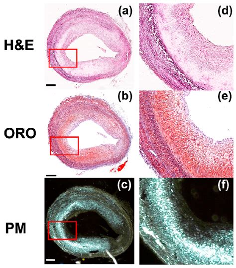 High-Contrast Imaging of Cholesterol Crystals in Rabbit Arteries Ex ...