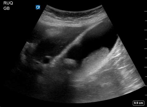 Image result for How to Remove Gallbladder Sludge