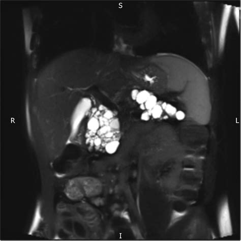 Pancreatic cystosis in cystic fibrosis | BMJ Case Reports