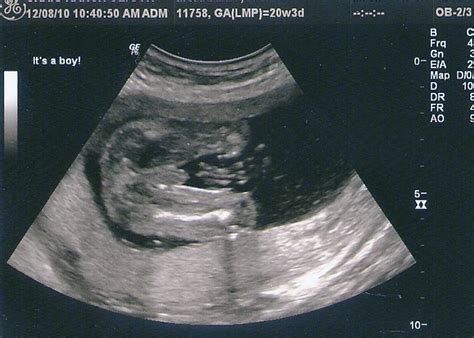 Its A Boy Ultrasound 20 Weeks