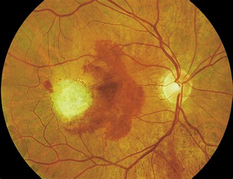 Wet Age-Related Macular Degeneration Linked to Hypertension - Ophthalmology Advisor