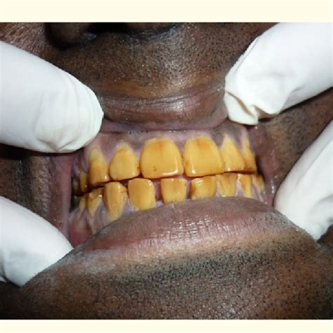 Yellowish discolouration with vertical grooves on labial surfaces of ...