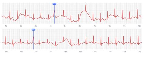 What Heart Palpitations and Irregular Heartbeats Look Like on Your Watch ECG | Qaly