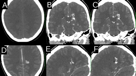 Image result for AVM Brain