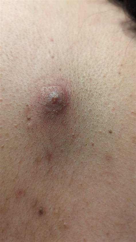 Big pimple aftermath, what is this/what to do? : r/DermatologyQuestions